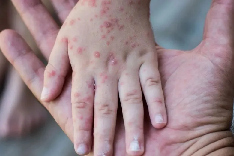 Чому зростає кількість випадків вірусу Коксакі та як захистити дітей